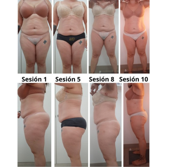 Tratamiento Jolie Action Real